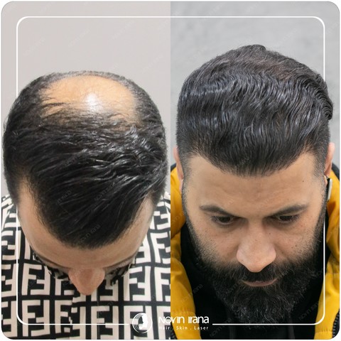 کاشت مو بدون درد و جراحی! دروغی تبلیغاتی برای جذب مشتری نمونه کاشت موی موفق انجام شده